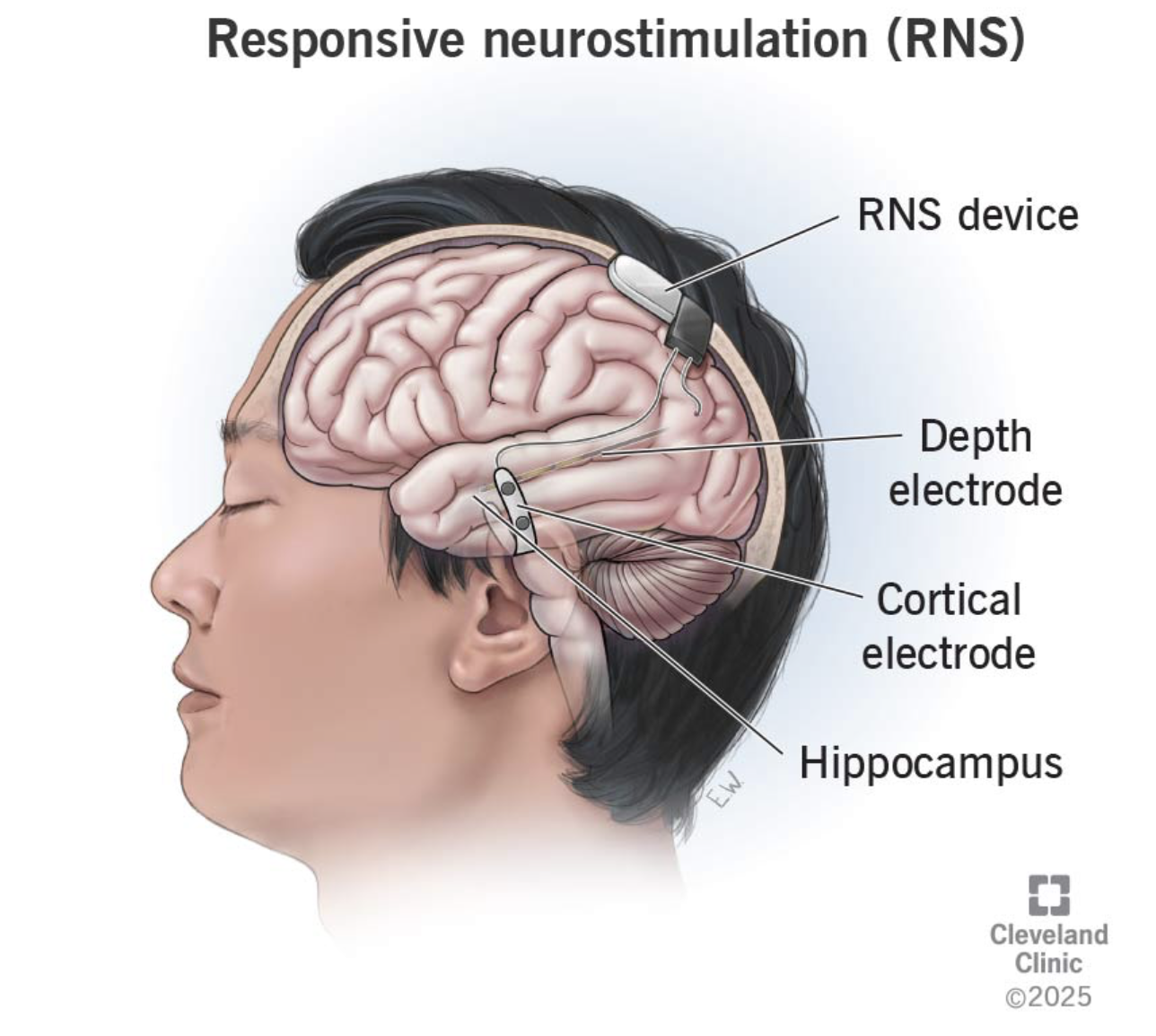 Estimulación Magnética Transcraneal (EMT) en Epilepsia