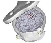 Estimulación Magnética Transcraneal en Parkinson
