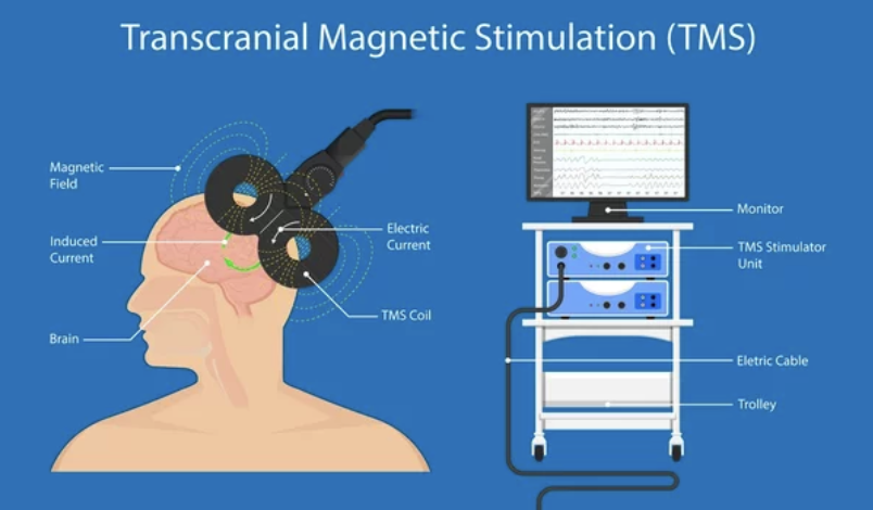 Estimulación Magnética Transcraneal (EMT) en Autismo